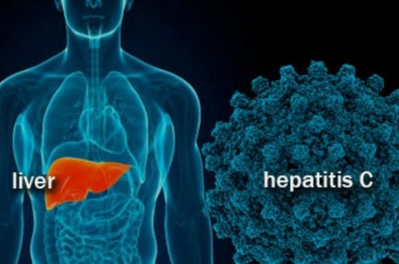 Hepatitis-C-1-560x371